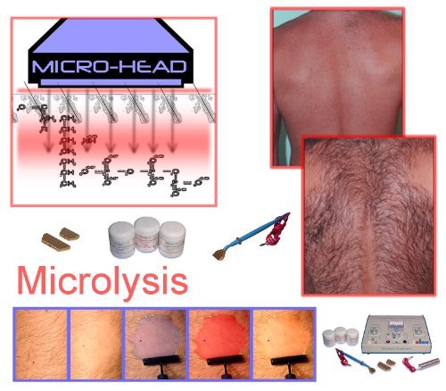 Microlysis Réz Tipp pótlására Tartós szőrtelenítés, Az Arc, Bikini Vonal, meg a Testet.